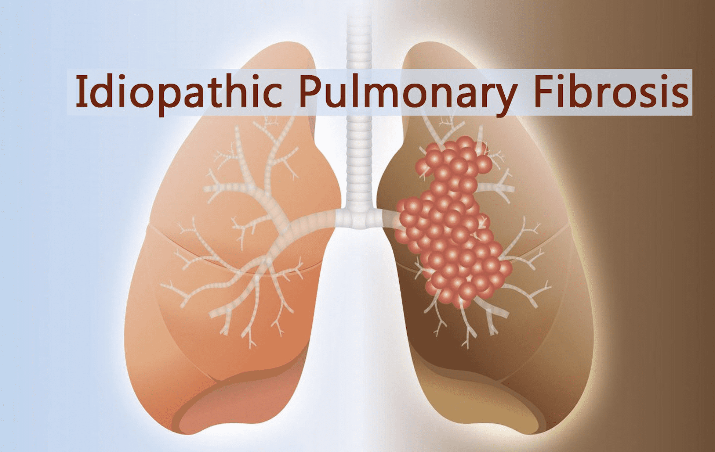 Image source: Medicaldialogues. Idiopathic pulmonary sclerosis IPF example KellyOnTech